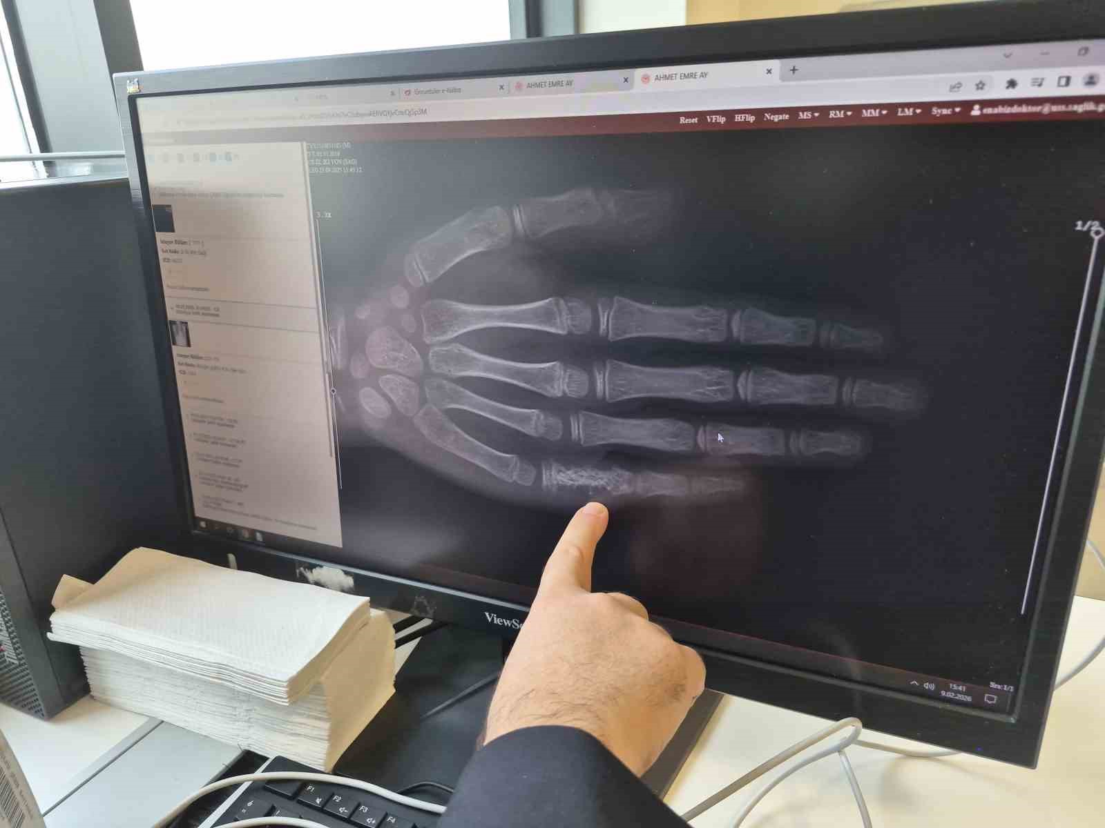 Eskişehir’de her ay 5 ila 7 çocuğa kanser tanısı konuluyor